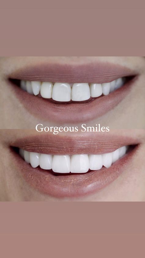 Teeth Veneers Perfect Smile Teeth Women, Veneers Teeth Styles, Perfect Smile Teeth, Baby Tooth Decay, Pretty Teeth, Veneers Teeth, Crystal Makeup, Porcelain Veneers, Beautiful Teeth