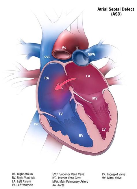 Hole In Heart, Bicuspid Aortic Valve, Cardiac Sonography, Atrial Septal Defect, Cardiothoracic Surgery, Heart Anatomy, Congenital Heart Defect, Heart Defect, Cardiac Nursing