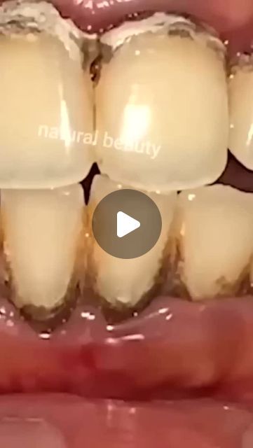 Healthy Tips on Instagram: "Remove Tartar and Yellowness From Your Teeth #teethwhitening #yellowteeth #remedy #naturalremedies" How To Remove Tartar From Teeth, Remove Tartar From Teeth At Home, Teeth Whitening Before And After, Instant Teeth Whitening Diy, Yellow Teeth Remedy, Instant White Teeth, Turmeric Teeth Whitening, White Teeth Tips, After Wisdom Teeth Removal