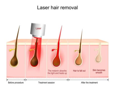 Diode Laser Hair Removal, Laser Skin, Laser Hair, Laser Hair Removal, Diode, Hair Removal, How Many, Skin, Hair