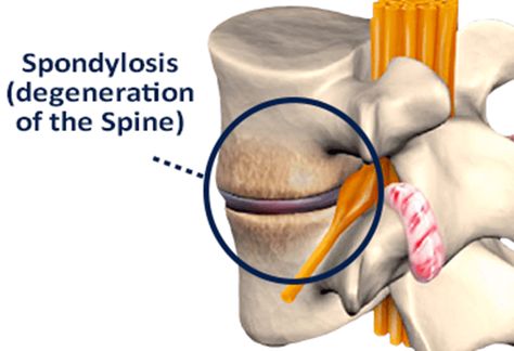 Low Back Pain Due to Lumbar Spondylosis, Degenerative Joint Disease affecting Lower Lumbar Vertebrae, Disc, And Related Nerve Root. Spinal Anatomy, Lumbar Spondylosis, Lumbar Vertebrae, Spinal Degeneration, Lumbar Lordosis, Hamstring Muscles, Intervertebral Disc, Cervical Spondylosis, Spinal Column