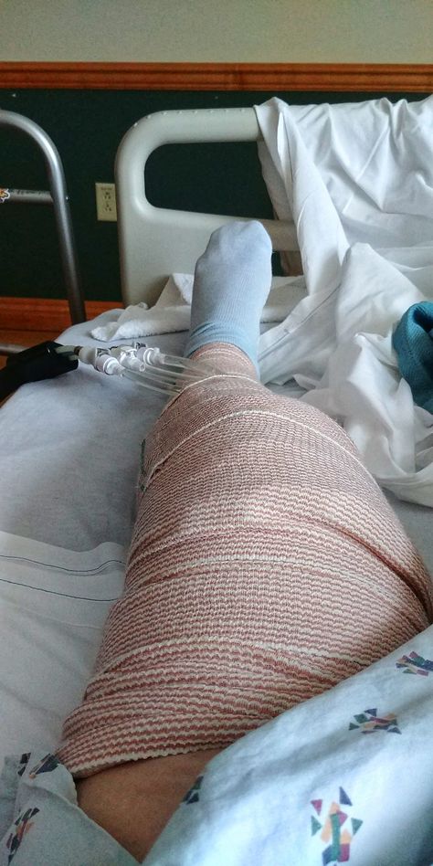 my "bee's knee" just got replaced yesterday. looking forward to living life again. Leg Fracture Snapchat, Broke Leg Snapchat, Hospital Room Snapchat Stories, Iphone Screen Repair, Hospital Admit Hand Pics, Hospital Photography, Joker Hd Wallpaper, Leg Injury, Knee Wraps