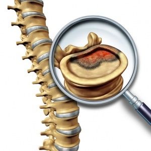 Spinal injury can be detected by a spine surgeon. Types Of Bones, Spinal Surgery, Spinal Injury, Types Of Cancers, Le Point, Bones, University, Health