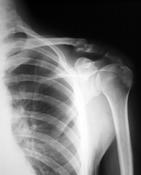 Left Shoulder Xray - Fx Clavicle Shoulder Xray, Injury Aesthetic, Medical Artwork, Bicycle Accident, Broken Ribs, Bone Fracture, Knee Exercises, Shoulder Injuries, Collar Bone