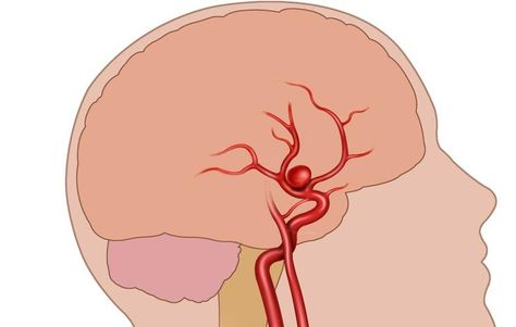 What Is a Brain Aneurysm? http://www.menshealth.com/health/brain-aneurysm-warning-signs/slide/1 Brain Aneurism, Brain Surgeon, Loss Of Balance, Congenital Heart, Coronary Arteries, Learn Yoga, 2023 Trends, Nails 2023, Men's Health