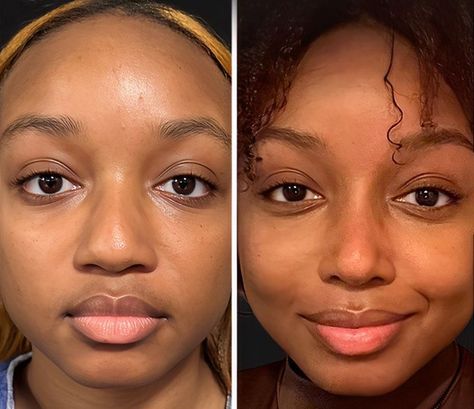 The Cosmetic Lane on X: "Rhinoplasty 👃🏾✨ The idea of an ethnic rhinoplasty is to preserve as much ethnicity as possible while attempting to address concerns patients have with their noses. https://t.co/eeaVvzxVz8" / X Lower Blephoraplasty Before And After, Bulbous Nose Rhinoplasty Before After, Wide Nose Rhinoplasty, Possessed Makeup, Ethnic Nose Job, Korean Rhinoplasty, Bad Nose Jobs, Nose Rhinoplasty, Jaw Reduction Surgery