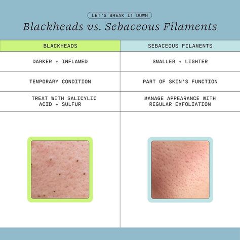 Sebaceous Filaments Vs Blackheads, Sebaceous Filaments, Pimple Cream, Skin Advice, Pore Strips, Types Of Acne, Aesthetic Medicine, Clear Skin Tips, Be The Reason