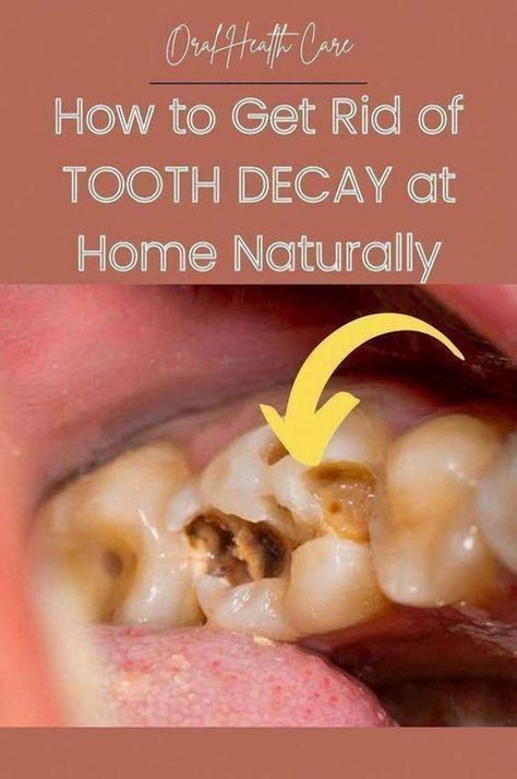 Help your children develop good dental habits from a young age to ensure they enjoy healthy smiles throughout their lives. #KidsDental #Parenting Natural Cavity Repair, Heal A Cavity Naturally, Cavity Remedy, Cavities In Kids, Reverse Cavities, Teeth Tips, Tooth Decay Remedies, Heal Cavities, Healthy Teeth And Gums