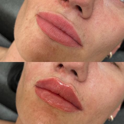 My client had her lips done elsewhere, but wasn’t happy with her cupids bow… 1ml dermal filler used to create a cupids bow and add volume. My client is a fellow big lip lover so I added some juice whilst keeping them flat, lifted and defined. This wasn’t an easy task as her previous injector placed filler in place that shouldn’t be injected. But I am so happy with the end result and so is she ☺️☺️☺️☺️☺️ #aestheticsessex #aestheticsbenfleet #lipfilleressex #lipfillerbenfleet #dermalfiller... Cupids Bow, I Am So Happy, Dermal Fillers, Lip Fillers, So Happy, The End, Juice, Lips, Quick Saves