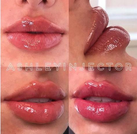 Lip Plumber, Heart Shaped Lips, Lips Inspiration, Botox Lips, Green Lips, Facial Fillers, Facial Contouring, Lip Filler, Celebrity Skin