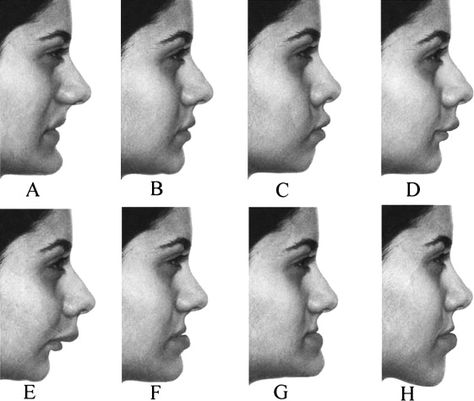 Introduction Improved facial esthetics can be fully achievable only if facial preferences of the treated group are known. We hypothesized that facial profile perception and preferences could be inf… Facial Deformity, Facial Harmony, Facial Profile, Facial Esthetics, Constipation Relief, Improve Digestion, Shape Of You, Digestive Health, Herbal Remedies