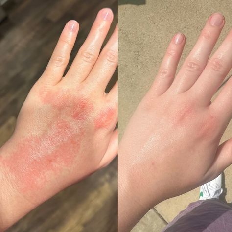 Today starts National Eczema Week so I thought I’d shine a little spotlight on this overnight transformation! I have battled with eczema since I was a baby & the relief is not always this speedy… There have been many times where I cannot open my hands fully, or my skin cracks open when I hold a pen, & constantly being asked “did you get in a fight?” because of the inflammation & sores on my knuckles. I went YEARS before discovering my skin wasn’t ‘just dry’ and that I didn’t need another cre... Road Rash, Burn Mark, Open When, Dermatology, My Skin, Pen, Road, Collage, Tumblr