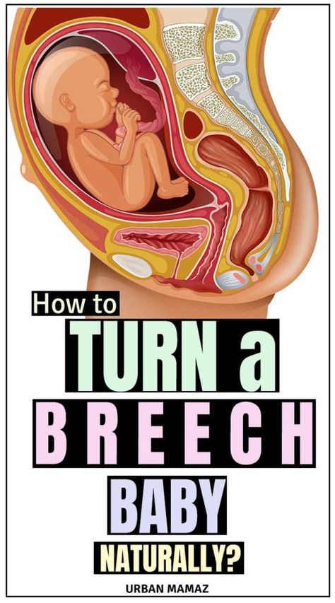 Is your baby in a breech position? Check out these natural ways to turn your breech baby to the right position - Cephalic position! Ways to turn your breech baby naturally- click here》》》 #breechbaby #breechbirth #pregnancy #pregnancytips Breech Baby Exercises, Turn A Breech Baby, Breech Birth, Breech Baby, Breech Babies, Birthing Ball, Pregnancy Checklist, Baby Workout, Pregnancy Labor