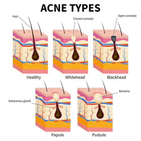 Acne Types, Skin Anatomy, Facial Procedure, Anatomy Medical, Types Of Acne, Skin Structure, Skin Science, Diagram Design, Summer Skin