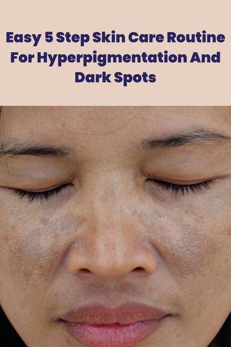 Getting rid of stubborn dark spots and hyperpigmentation is easier now. Know the best 5 step skin care regimen here for clear skin. Dark Patches On Face, Face Hyperpigmentation, Skin Care Hyperpigmentation, Acne Overnight, Treating Hyperpigmentation, Oily Skin Acne, Face Routine, Dark Spots On Face, Brown Spots On Face