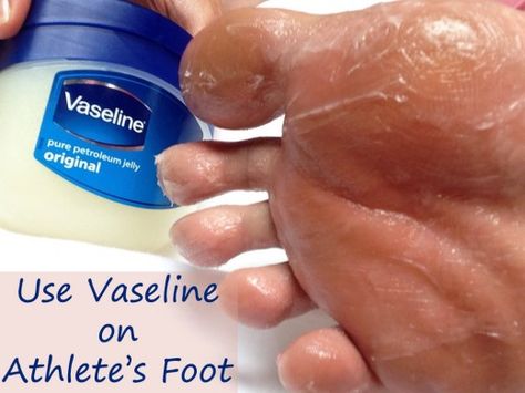 Vaseline for Athlete's Foot Uses For Vaseline, Benefits Of Vaseline, Vaseline Uses, Winter Beauty Tips, Vaseline Beauty Tips, Skin Hand, Athletes Foot, Petroleum Jelly, Beauty Tips For Skin