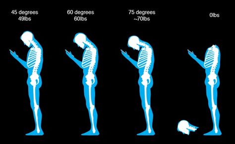 If You Keep Texting, Your Head Will Fall Off - Countering the claim that texting is ruining spines - BY JAMES HAMBLIN - Image: Lauren Giordano/The Atlantic Spine Problems, Text Neck, Forward Head Posture, Trending Topic, Medical Anatomy, Bad Posture, Neck And Back Pain, Poor Posture, Very Scary