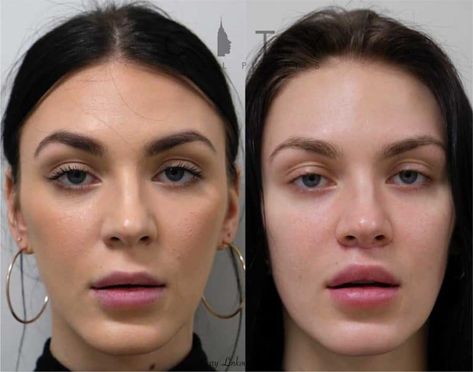 Lip Lift, Facial Fillers, Lip Augmentation, Lip Enhancement, Facial Plastic, Before After Photo, Scar Tissue, After Photos, Plastic Surgeon