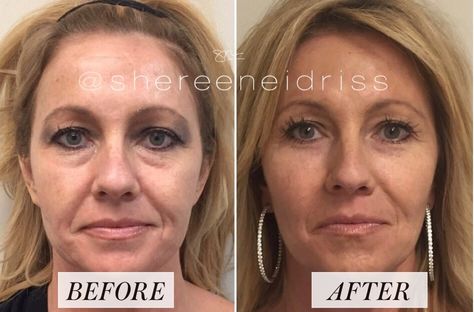 Everything You've Ever Wanted to Know About Fillers Cosmetic Injections, Health Tricks, Smokers Lines, Cosmetic Fillers, Chin Filler, Under Eye Fillers, Face Fillers, Cheek Fillers, Beauty Procedures