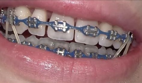 Dark Blue Braces, Light Blue Braces, Braces Colors Combinations, Cute Braces Colors, Grillz Teeth, Braces Tips, Getting Braces, Cute Braces, Brace Face