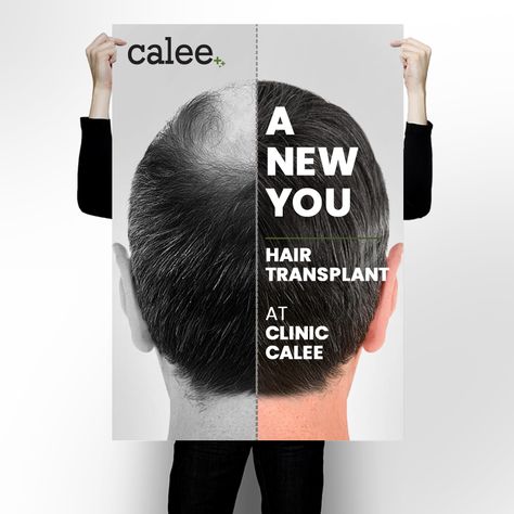 Be Bald Free in a matter of hours with the best techniques in Hair Transplant. For more info call now on 8448593172 / 73. . ✅ Free Consultation ✅ Easy Emi's! . #hairtransplant #haircare #hair #goodhair #transplant #hairtransplantfut #haircarespecialist #calee #cliniccalee Hair Transplant Ads, Hair Grower, Hair Poster, Hair Implants, Skin Care Center, Skin Facts, Skin Care Business, Cosmetic Clinic, Types Of Skin