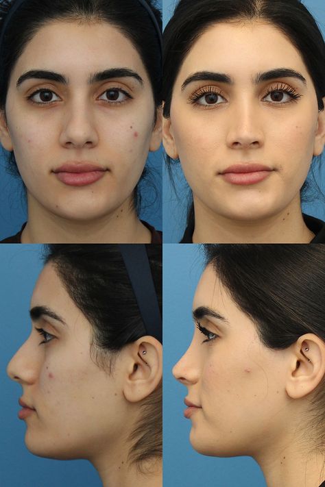 Lip Plastic Surgery, Bad Nose Jobs, Nose Surgery Rhinoplasty, Celebrity Surgery, Bulbous Nose, Plastic Surgery Fail, Rhinoplasty Nose Jobs, Face Surgery, Plastic Surgery Gone Wrong