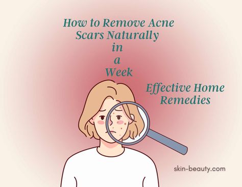 How to Remove Acne Scars Naturally in a Week: Effective Home Remedies Are you tired of acne scars stealing your confidence and affecting your social life? Worry no more! We have discovered effective home remedies, daily skincare routines, and dietary changes that can help you learn how to remove acne scars naturally in a week. Join us on this journey to regain your radiant skin and say goodbye to stubborn acne scars. Acne Skin Care Products, Scar Remedies, Face Mapping Acne, Stubborn Acne, Pimple Scars, Oily Skin Acne, Acne Face Mask, Severe Acne, Skincare Routines