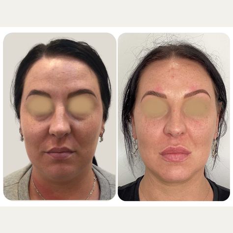 Over a series of sessions we have performed volumising injections and muscle relaxants to: + improve darkening and hollowing under the eyes + support the cheek area and reduce the depth of the nasolabial area + increase the lip size, while keeping with her original, beautiful shape + addressed dynamic lines of the forehead and forehead, while providing elevation to the lateral brow + improved skin hydration and reactivity with advice on home care and diet Dynamic Lines, Cosmetic Treatments, Skin Hydration, Hydrate Skin, Home Care, A Series, Lips, Diet, Skin