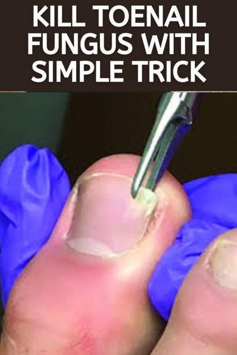 Fungal Infection Remedies, Toenail Health, Toenail Fungal Infection, Nail Remedies, Toenail Fungus Remedies, Nail Fungus Remedy, Nail Infection, Fungal Nail, Ingrown Toe Nail