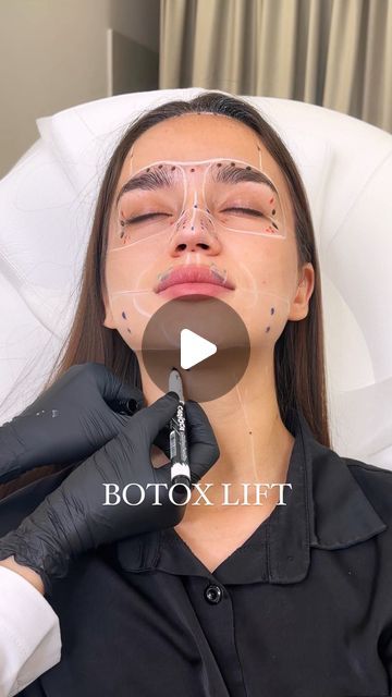 Marina Aisina | КОСМЕТОЛОГИЯ ГУБЫ МОСКВА | RUSSIAN LIPS DUBAI on Instagram: "The Botox lift is a technique that helps achieve a unique tissue lift @lfk.academy 

By injection specific muscle groups in combination, we deliver outstanding results 🌟

Book your appointment now to experience the transformative effects!
.
.
.

#cosmetologycourse#lipstrainingcourses #russianlipstraining#lowangle#plasticsurgerylondon#plasticsurgery#botox#botoxlondon#botoxdubai#botoxmexico#botoxparis#botoxonlinecourse#botoxlessons#cosmetologyschool#plasticsurgery#ботокс#ботоксмосква#сделатьботокс#botoxinjections#botoxfacial#botoxface#bótox#dubaibotox #clinicdubai #clinicuae #botoxdubai #botoxuae" Botox Face Lift Before And After, Botox Lips Before And After, Botox And Fillers Before After, Botox Injection Sites Diagram, Masseter Botox Before And After, Botox Forehead, Botox Results, Botox Injection Sites, Botox Clinic