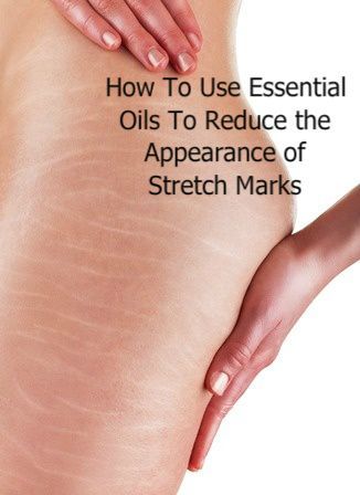 How To Use Essential Oils To Reduce Stretch Marks. One aromatherapy blend: 20 drops helichrysum 1 tablespoon rosehip seed oil 5 tablespoons other carrier oil of your choice More at aromatherapyandmassage.com Stretch Mark Essential Oils, Diy Stretch Mark Oil, Pregnancy Stretches, Strech Marks, Natural Things, Aromatherapy Recipes, Stretch Mark Cream, Stretch Mark Removal, Coconut Oil Uses