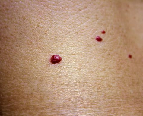 Cherry Angioma | Beverly Hills MD Cherry Angioma Removal, Red Skin Spots, Cherry Angioma, Red Moles, Varicose Vein Remedy, Skin Images, Allergy Remedies, Chest Congestion, Skin Spots