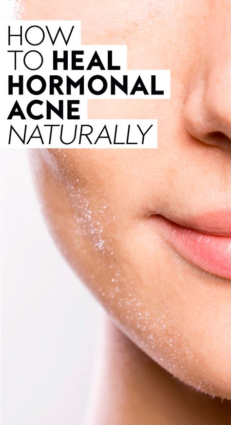 How to Heal Hormonal Acne Naturally | Stubborn hormonal cystic acne or jawline breakouts can be a huge bummer. Read more about underlying acne causes, natural remedies, and home treatments so you can find a skincare routine that boosts your confidence and leaves you with glowing, healthy skin.   #womenshealth #healthtips #healthy #tipsforwomen #personalcare #skincaretips #skincare Neck Acne Causes, Hormonal Cystic Acne, Jawline Acne, Neck Acne, Treating Cystic Acne, Back Acne Remedies, Hormonal Acne Remedies, Chin Acne, Hormonal Breakouts