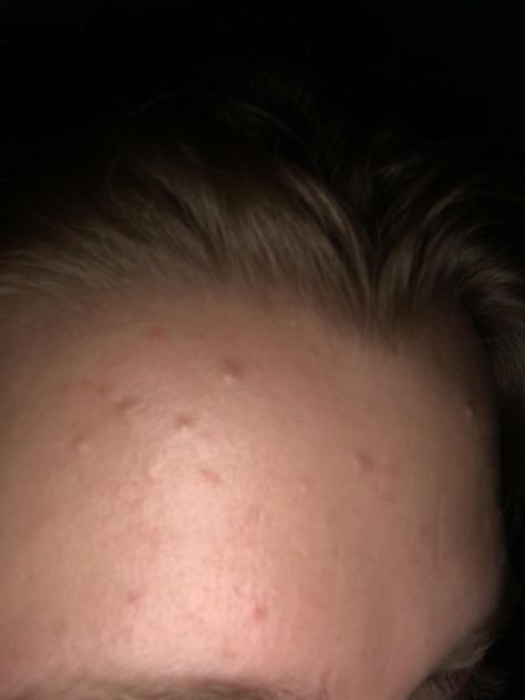 [Routine Help] How do I get rid of these small dents? Photo is fairly low quality but my forehead looks bumpy all over! How Do I Get, Starter Pack, Low Quality, Skin, Hair