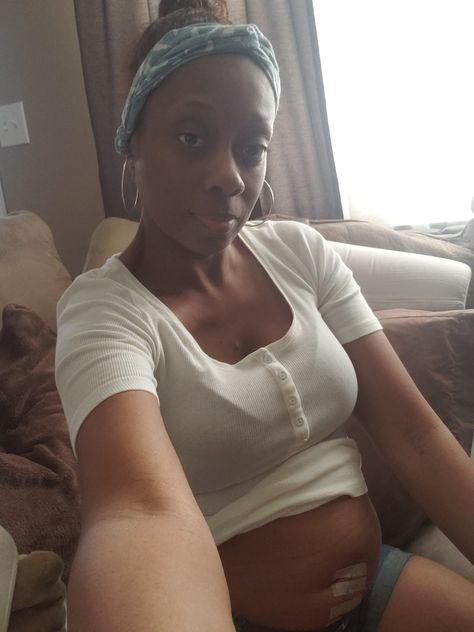 Fibroids Can get Dangerous (Part 1)... Myomectomy Before And After, Fibroid Belly Before And After, Fibroid Surgery, Fibroid Tumors, Low Estrogen, Swollen Legs, Leg Pain, Me First, Before And After Pictures