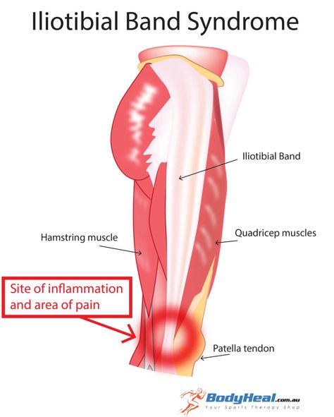 Tight It Band, Iliotibial Band, Back Pain Stretches, Knee Ligaments, Bursitis Hip, Band Stretches, It Band Stretches, Hamstring Muscles, Hip Problems