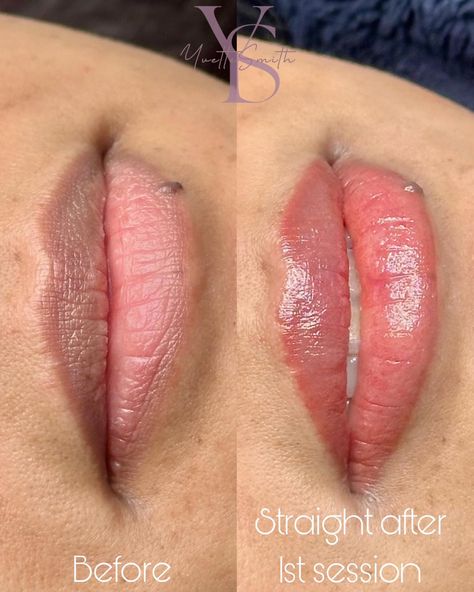 These pics are immediately after the first session of dark lips neutralisation- The goal of lip neutralisation is to be able to lighten the pigmentation for those with cool or dark-toned lips in which we neutralise the darkness in the lips to achieve a more desired colour. This creates a more natural, even and subtle colour 🙌🏻🙌🏻💋💋 Swipe ⬅️ for before and after photos 🙌🏼🙌🏼⠀⠀⠀⠀⠀⠀⠀ Honoured to be a Pro Artist for the @inkofcocotattooskincare team 🧑🏼‍🎨 & @dermacalmbeauty - Skincare and PMU Aft... Two Toned Lips Natural, Pmu Aftercare, Laser Removal, Dark Lips, After Photos, The Goal, Permanent Makeup, Blush Makeup, The Darkness