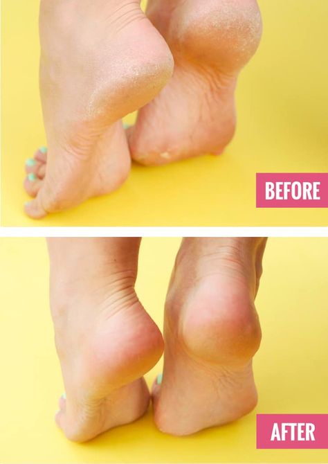 Apple Cider Vinegar Feet Soak, Rough Heels How To Get Rid Of, Soften Heels, Foot Soak For Calluses, Listerine Foot Soak, Diy Foot Soak, Antiseptic Mouthwash, Dry Heels, Dry Cracked Heels