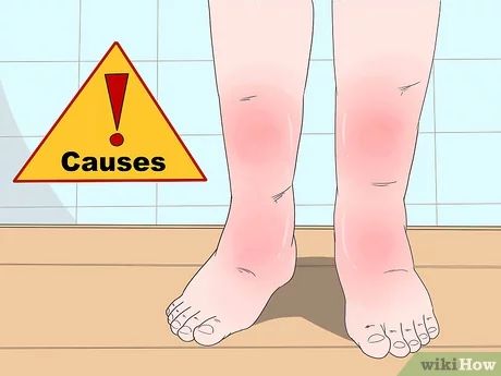 Swollen Legs Remedies, Reduce Leg Swelling, Swelling Remedies, Leg Swelling, Sore Legs, Swollen Knee, Leg Veins, Swollen Ankles, Swollen Legs