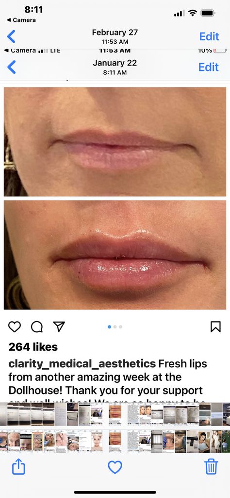 Lip Flip Vs Filler, .5 Lip Filler, Light Lip Filler, Lip Model, Lip Blush, Lip Filler, Medical Aesthetic, Natural Lip, Lip Fillers