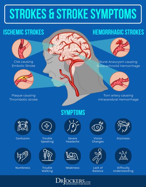 Cerebrovascular Disease: Causes, Symptoms & Solutions - DrJockers.com Dizziness Causes, Types Of Strokes, Medical Facts, Neurological Disorders, Medical Knowledge, Disease Prevention, Neurology, Medical Information, Sciatica