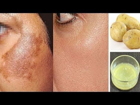 Botox Tips, Remedies For Hyperpigmentation, Skin Spot Remover, Skin Care Routine For 20s, Skin Pigmentation, Dark Spots On Skin, Skin Spots, Acne Scar Removal, Remove Dark Spots