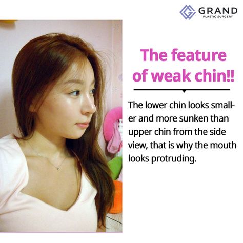 Complete a beautiful face with Grand’s weak chin correciton. 💙For free consultation💙 Tel: (+82) 70-7119-1580  Mobile: (+82) 10-7156-6546(Whatsapp, Line, Kakaotalk, Viber, iMessage)  Email: grandps.en@gmail.com  Facebook: facebook.com/grandplasticsurgery Webstie: eng.grandsurgery.com Pinterest : https://www.pinterest.co.kr/grandps_eng/ Tumblr: http://grandsurgery.tumblr.com/ Instagram: grandps_eng Weak Chin, Chin Surgery, Ancient Chinese Dress, Free Consultation, Plastic Surgery, Surgery, For Free, Tumblr, Hair Styles