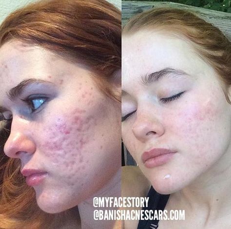 You've just finished your battle with acne, expecting your skin to go completely back to normal when you quickly realize that you've been left with a variety of indents, discolorations, lumps and bumps. Best Acne Cream, Severe Acne Remedies, Acne Scar Diy, Back Acne Remedies, Hormonal Acne Remedies, Cystic Acne Remedies, Chest Acne, Forehead Acne, Acne Causes