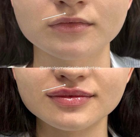 Subtle & Stunning Lip Enhancements 💋
Achieve natural-looking, fuller lips with our expertly applied lip fillers at Amaks Aesthetics. Whether you are adding volume, enhancing symmetry, or refining your shape, our goal is to give you results that boost confidence. Bigger Top Lip Filler, Lip Filler Small Mouth, Lip Filler Cupids Bow, Small Mouth Lip Fillers, Lip Filler Inspo 0.5ml, Natural Lip Filler Inspiration, Lip Filler Natural Look, Lip Filler On Small Lips, Natural Looking Lip Fillers