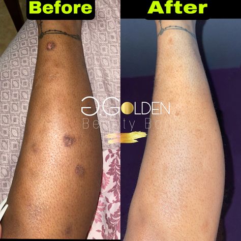 We make products to help women get rid of dark spots on their legs Get Rid Of Hyperpigmentation, Dark Inner Thighs, Dark Spots On Legs, Skin Anatomy, Multani Mitti, Spots On Legs, Skin Facts, Serious Skin Care, Acne Skincare Routine