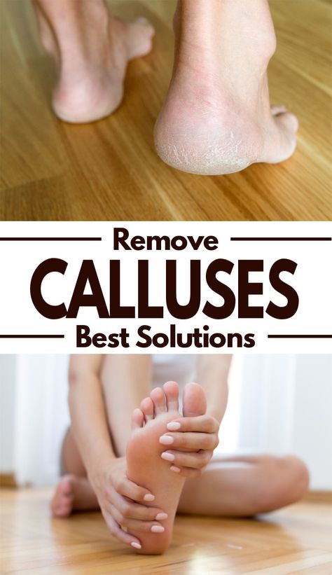 Feet Care Calluses, Best Callus Remover, Callous Remover, Electric Callus Remover, Foot Soak, Callus Removal, Interesting People, Simple Tricks, Dead Skin