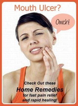 Home Remedies For Mouth Ulcers Ulcer Remedies Mouth, Mouth Ulcer, Remedies For Dry Mouth, Height Exercise, Home Remedies For Allergies, Home Remedies For Warts, Natural Remedies For Migraines, Snoring Remedies, Canker Sore