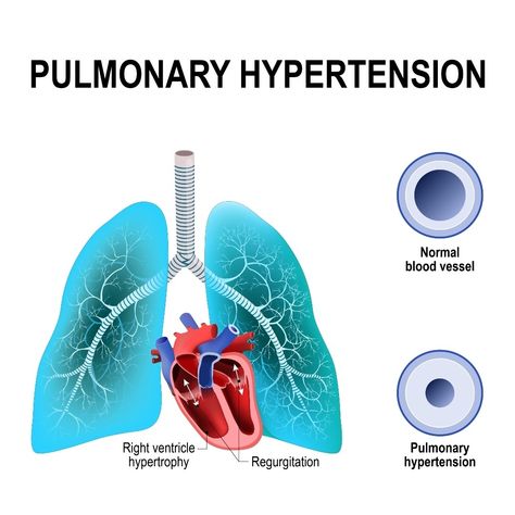 WebMD Pulmonary Arterial Hypertension, Calcium Channel Blockers, Lung Transplant, Metabolic Disorders, Congenital Heart, Nursing School Notes, Heart Problems, Chest Pain, Lower Blood Pressure