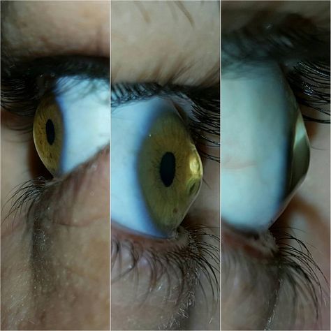 Keratoconus, conical cornea - The picture on the left is my left eye and the other two pictures are my right eye which is the worst one. Eye Defects, Eye Health Remedies, Eye Medicine, Diseases Pictures, Corneal Transplant, Puffy Eyes Remedy, Eyes Without A Face, Eye Facts, Parts Of The Eye